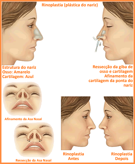 http://www.saintemarieabc.com.br/imagens/rinoplastia.gif